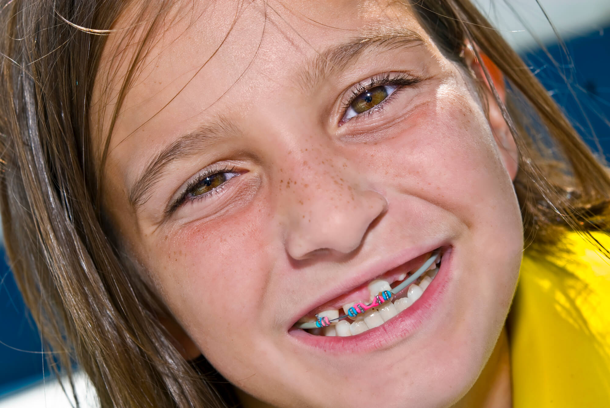 Do most children need braces? - McDonald Orthodontics